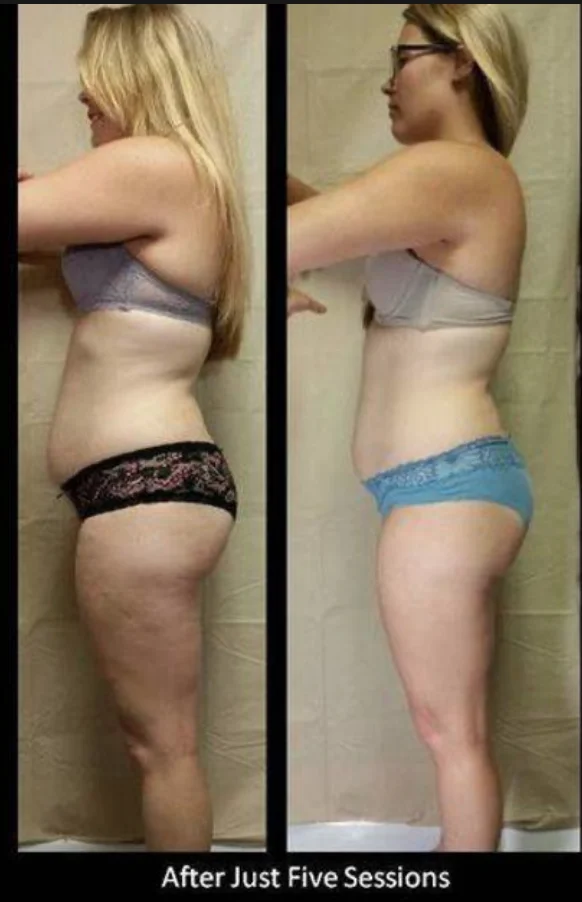 Visible inch loss after 5 Red Light Bed sessions