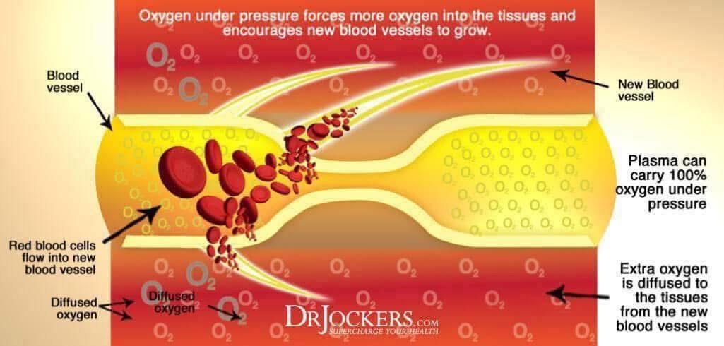 Diagram showing how oxygen under pressure forces more oxygen into tissues and encourages new blood vessel growth
