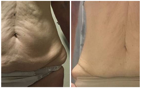 LipoMelt red light body contouring technology