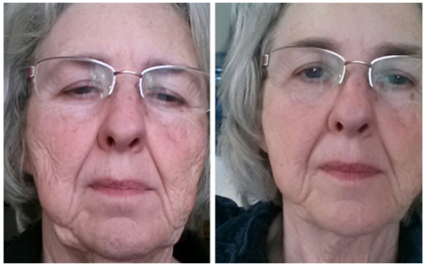 LipoMelt before and after results